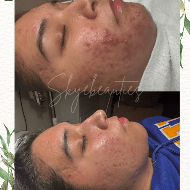 Radiance 6-Week Acne Solution at SkyeBeauties in Chandler, AZ
